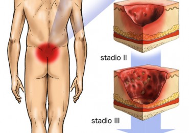 lesioni da pressione 370x260